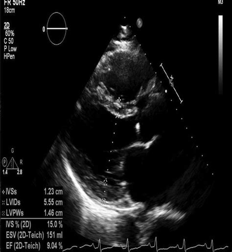 lv medical abbreviation|severely decreased Lv systolic function.